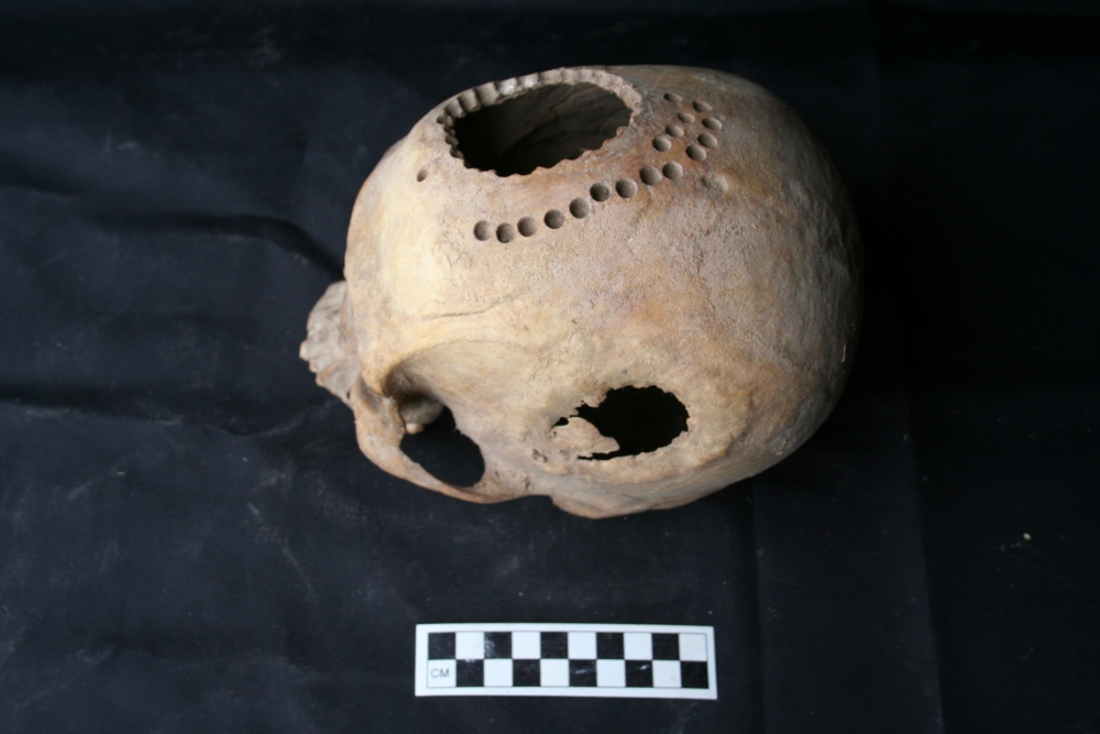 The Ancient Practice of Brain Surgery (Trepanation)