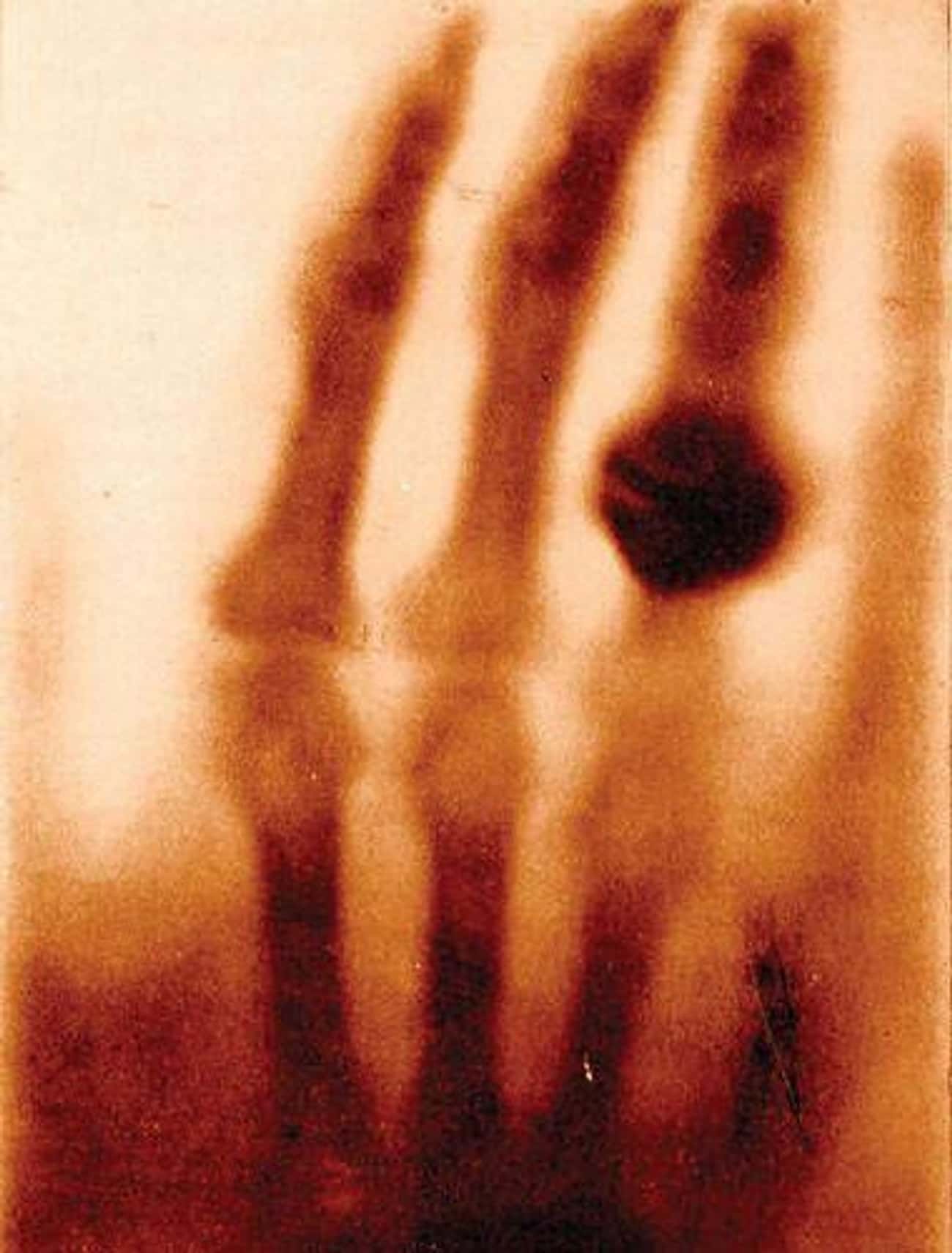 One Of The First X-Rays; December 22, 1895